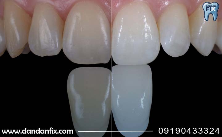 ایا میتوان دندان مصنوعی را سفید کرد؟