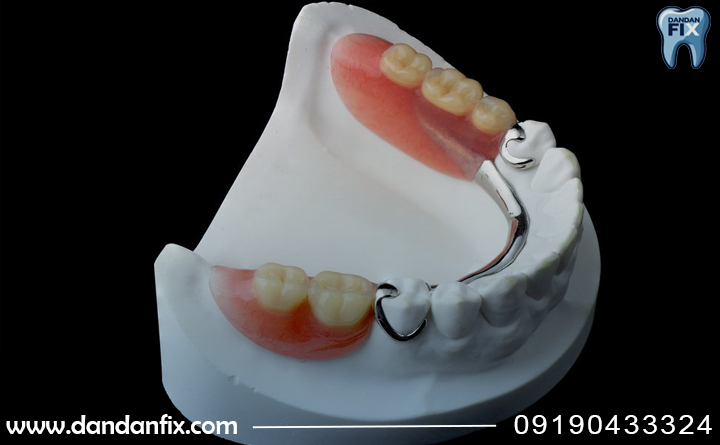 کاربرد پروتز پارسیل