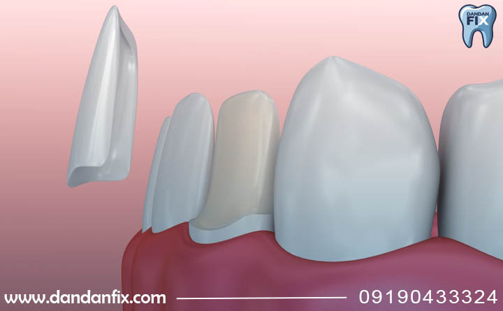 کامپوزیت دندان چیست؟