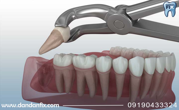 کشیدن دندان عقل