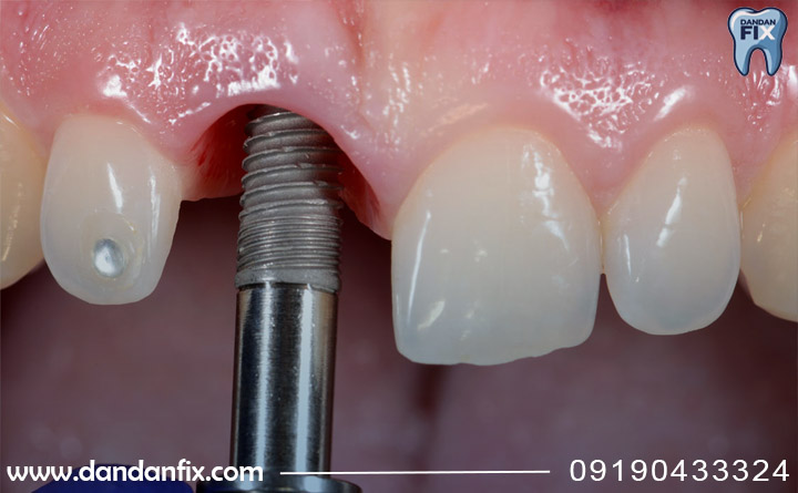 تفاوت بین ایمپلنت فوری و معمولی