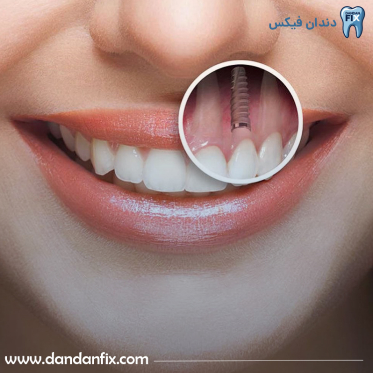ایمپلنت پانچ یا بدون برش چیست؟ مناسب چه افرادی است؟