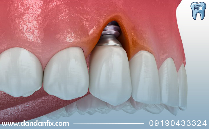 پری ایمپلنت چیه؟