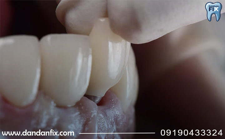 لق شدن ایمپلنت