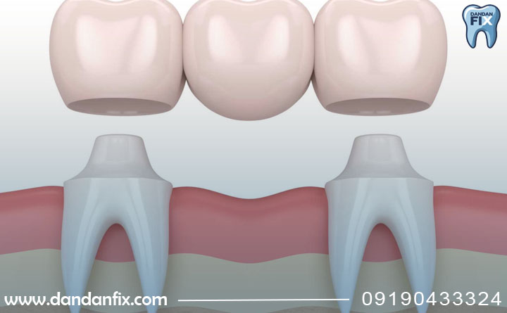 روش انجام بریج دندان