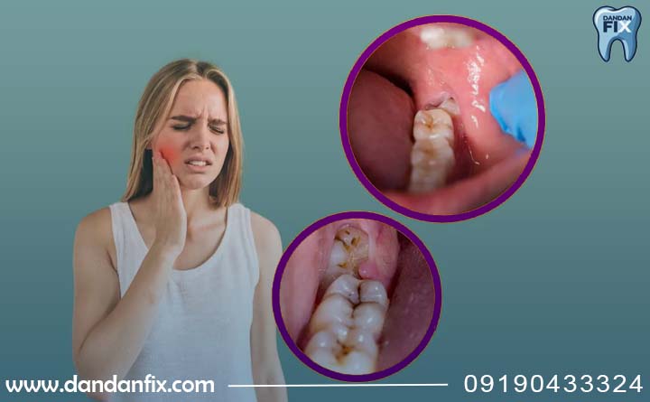 عوارض جراحی نکردن دندان عقل
