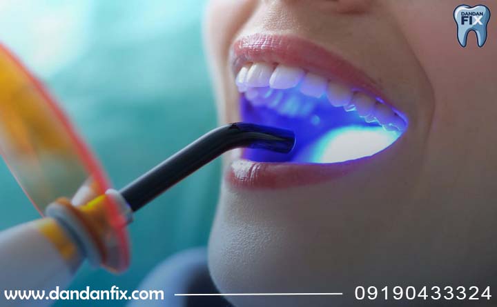 روش های بلیچینگ