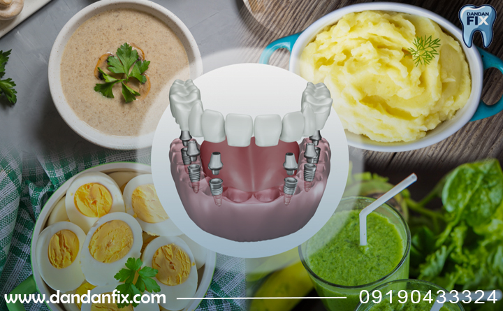  بعد از ایمپلنت چی بخوریم