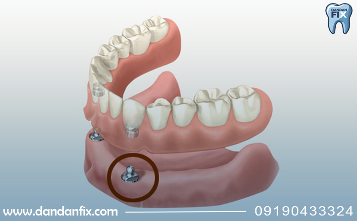 دندان مصنوعی برپایه ایمپلنت