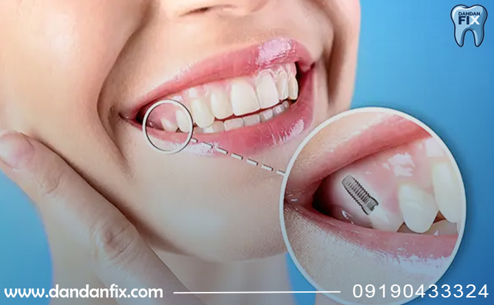 خطای کاشت ایمپلنت در زاویه نامناسب