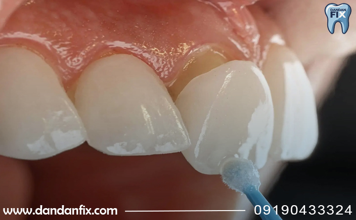 کامپوزیت دندان مصنوعی