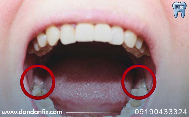 نهفتگی دندان عقل