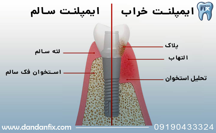 عمر ایمپلنت
