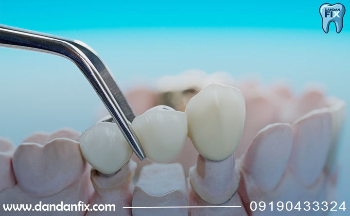 مدل های بریج دندان