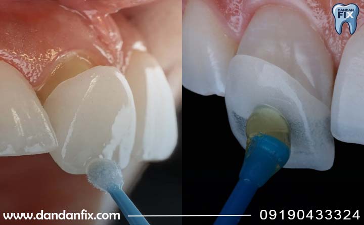 تفاوت لمینت و کامپوزیت