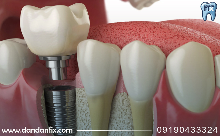 چرا ایمپلنت خراب میشه؟