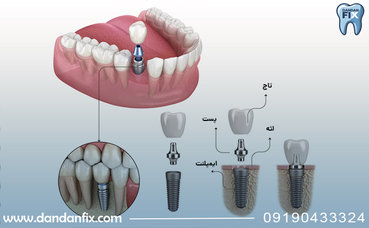 مراحل ایمپلنت دندان