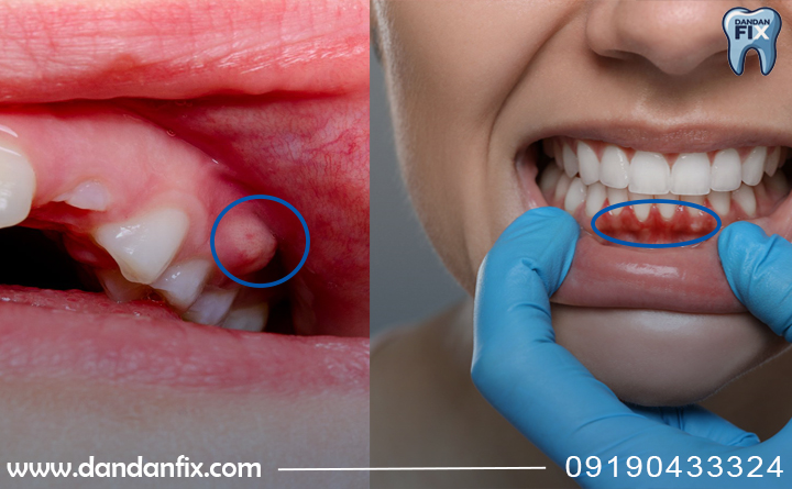 مقایسه آبسه دندان و آبسه لثه