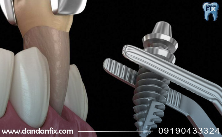 ایمپلنت فوری