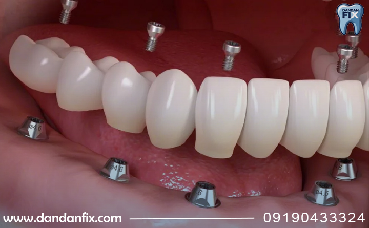 جوش خوردن ایمپلنت