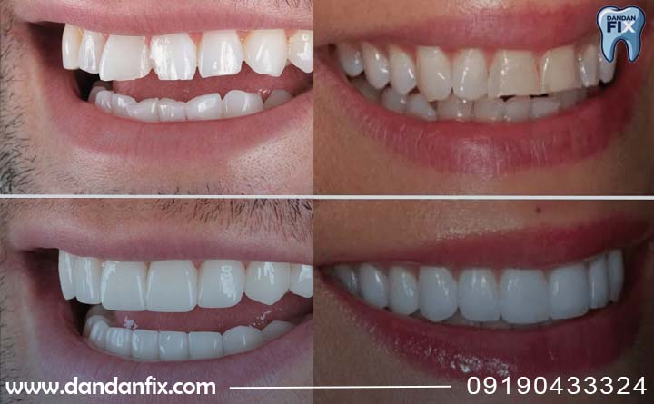 لمینت طبیعی دندان 