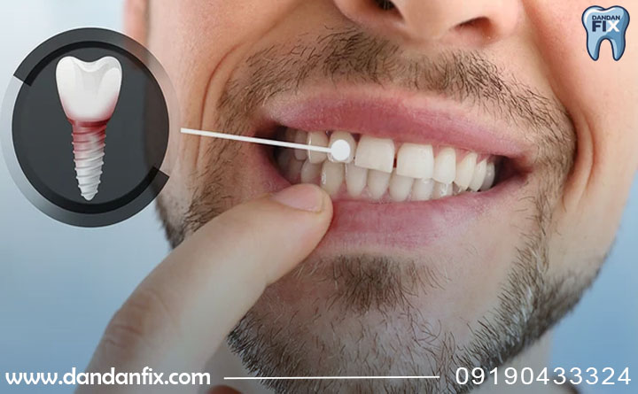 عوارض شایع کاشت ایمپلنت