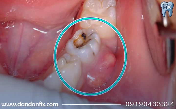  تشخیص آبسه دندان