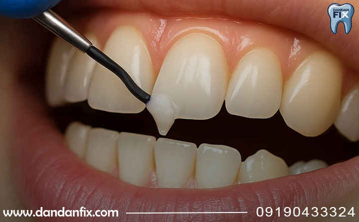 ترمیم به موقع کامپوزیت