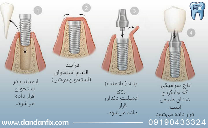 مراحل ایمپلنت کردن