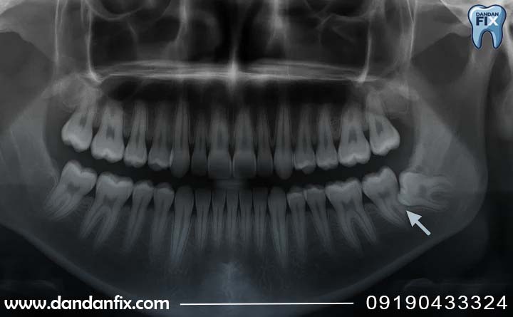 دندان عقل نهفته چگونه تشخیص داده میشود؟
