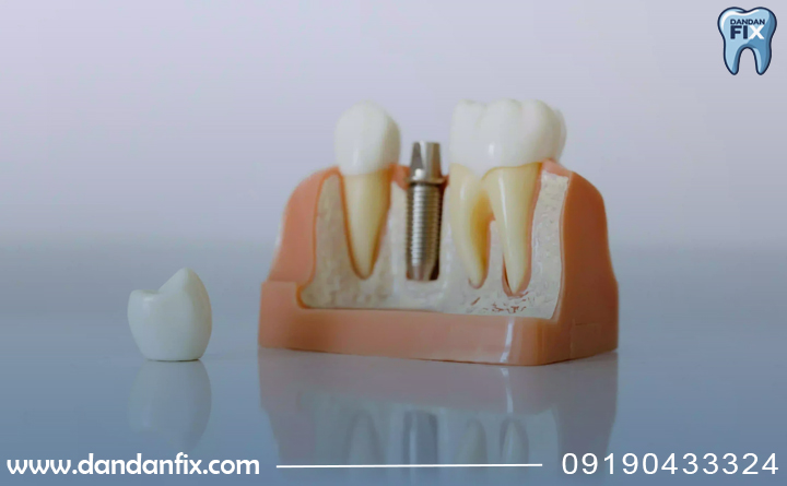  معایب ایمپلنت مدنتیکا