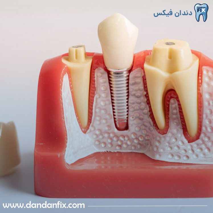 تفاوت ایمپلنت معمولی و ایمپلنت فوری در چیست؟ کدوم بهتره؟