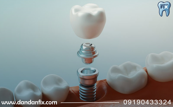 ایمپلنت دندان