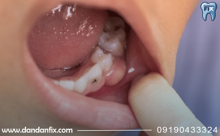 علائم عفونت دندان