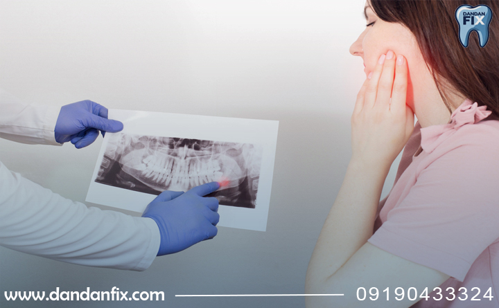 آبسه دندان خطریه؟