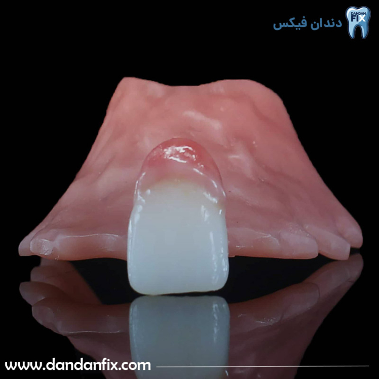 فلیپر دندان چیست؟ پروتز موقت برای جای یک تا سه دندان از دست رفته