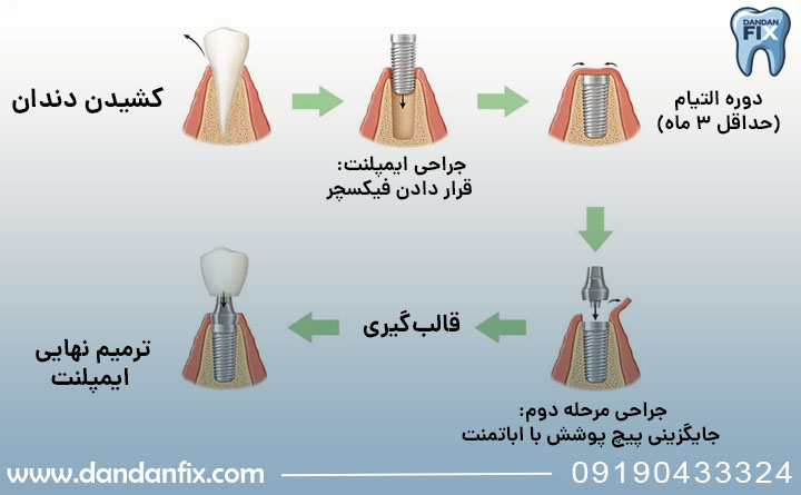 مراحل ایمپلنت دو مرحلهای