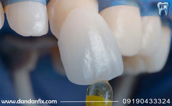 معایب لمینت