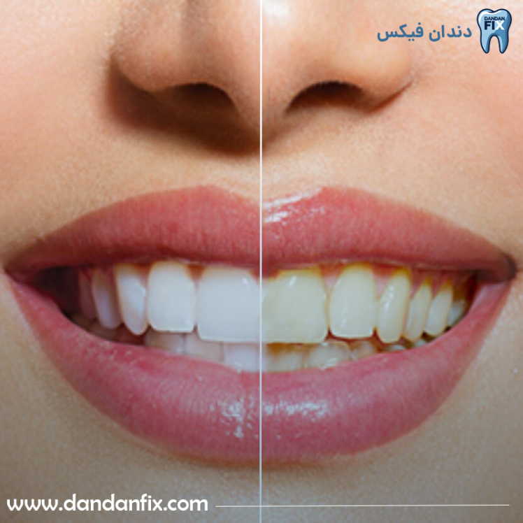 علل زرد شدن دندان‌ها چیست + راه‌های رفع زردی دندان