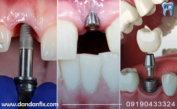 ایمپلنت دندان