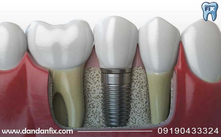 ایمپلنت معمولی بهتره یا فوری