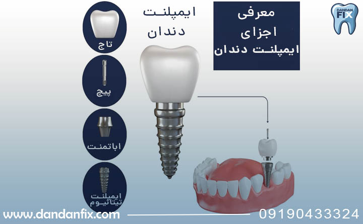 ایمپلنت دندان