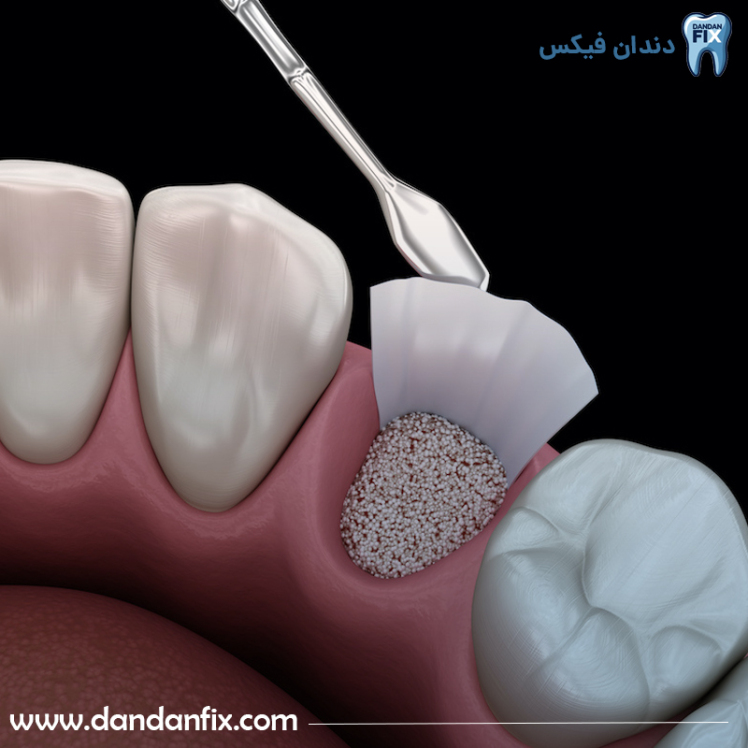 پیوند استخوان برای ایمپلنت دندان ضروری است؟ مراقبتهای بعد از پیوند استخوان در ایمپلنت