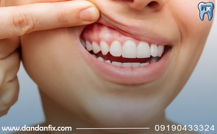 مراقبت از لثه ها