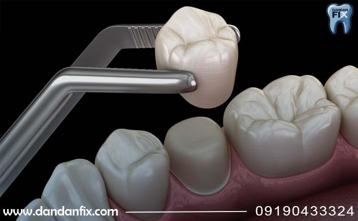 کی روکش کنیم؟