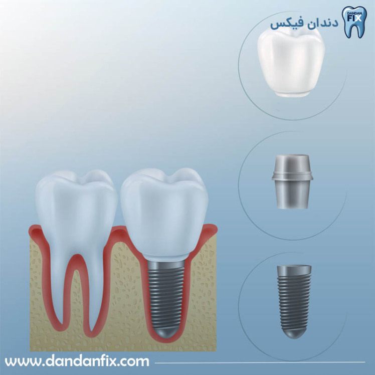 ایمپلنت یک مرحله‌ای چیست و برای چه افرادی مناسب است؟