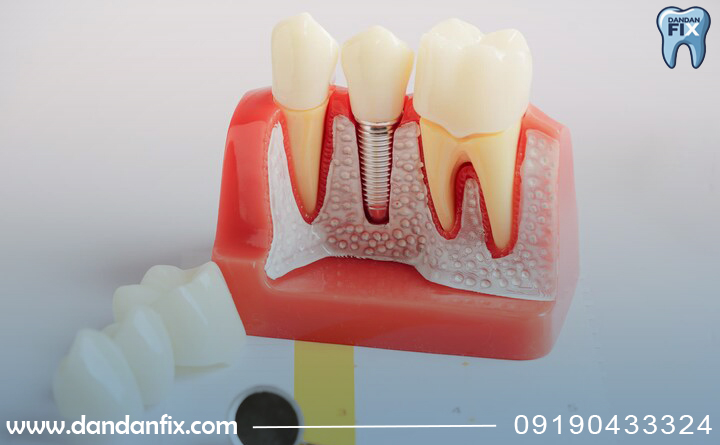 مراقبت های بعد از ایمپلنت 