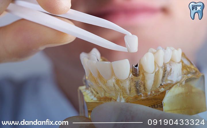 تعویض ایمپلنت دندان