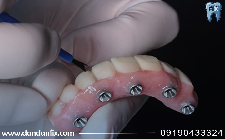 مزایای اوردنچر