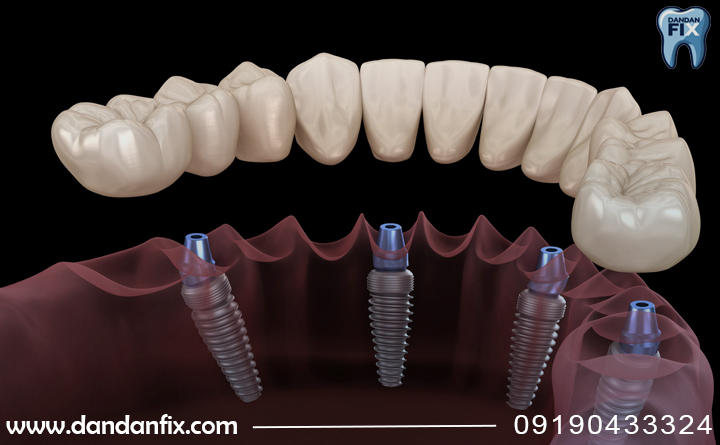 ایمپلنت دیجیتال